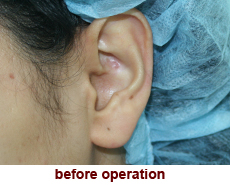 plastic-surgery-prominent-ear 